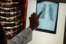 附图：结核病仍然是世界上最致命的传染病之一。